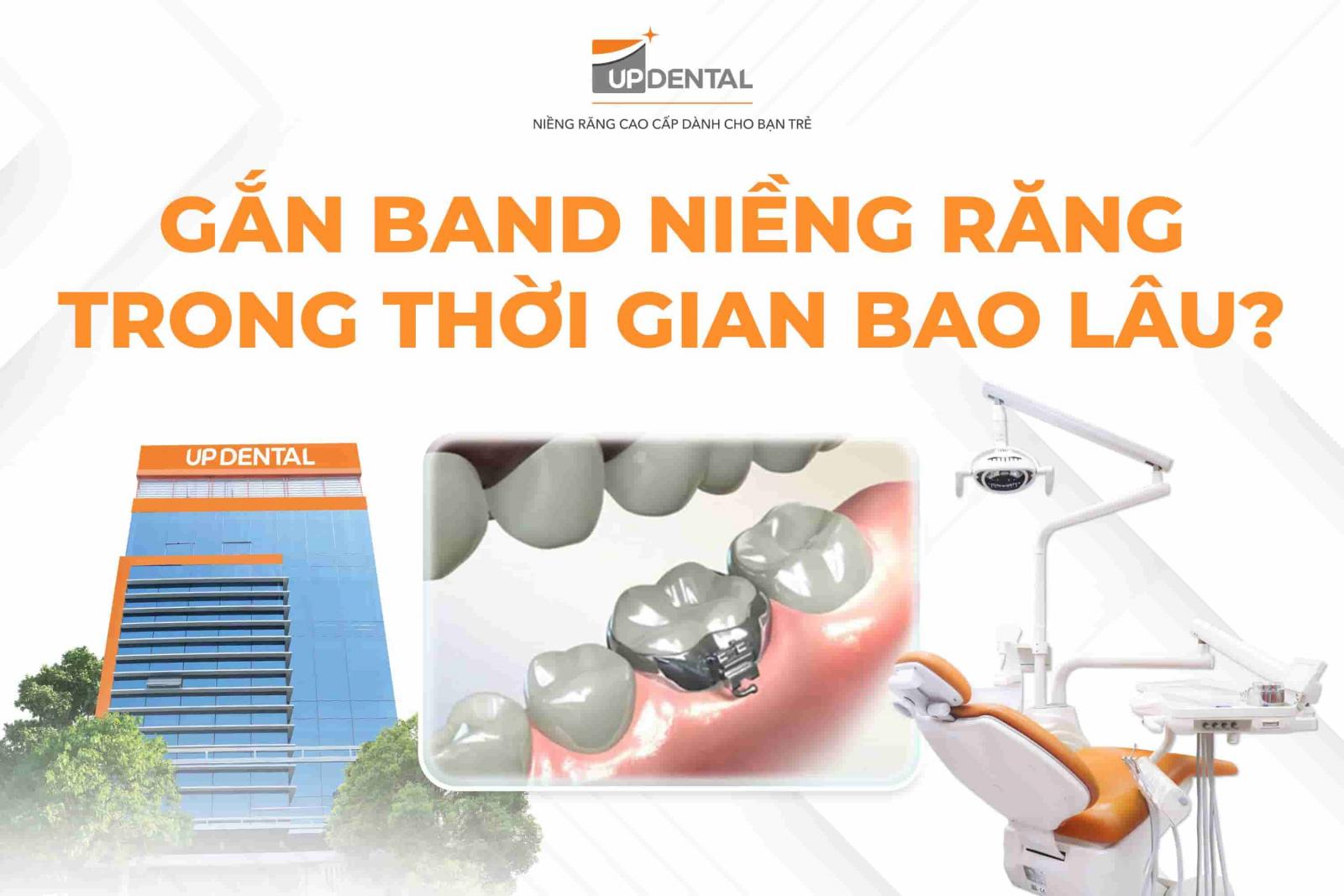 Gắn band niềng răng trong thời gian bao lâu?