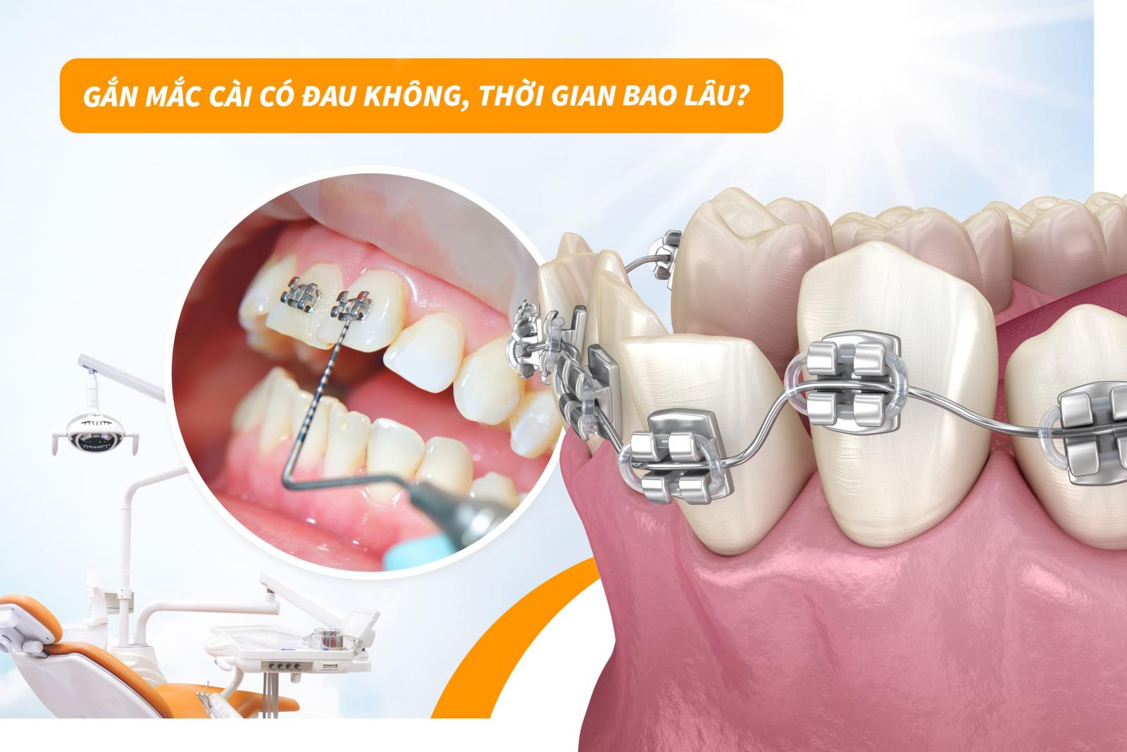 Gắn mắc cài có đau không, thời gian bao lâu?