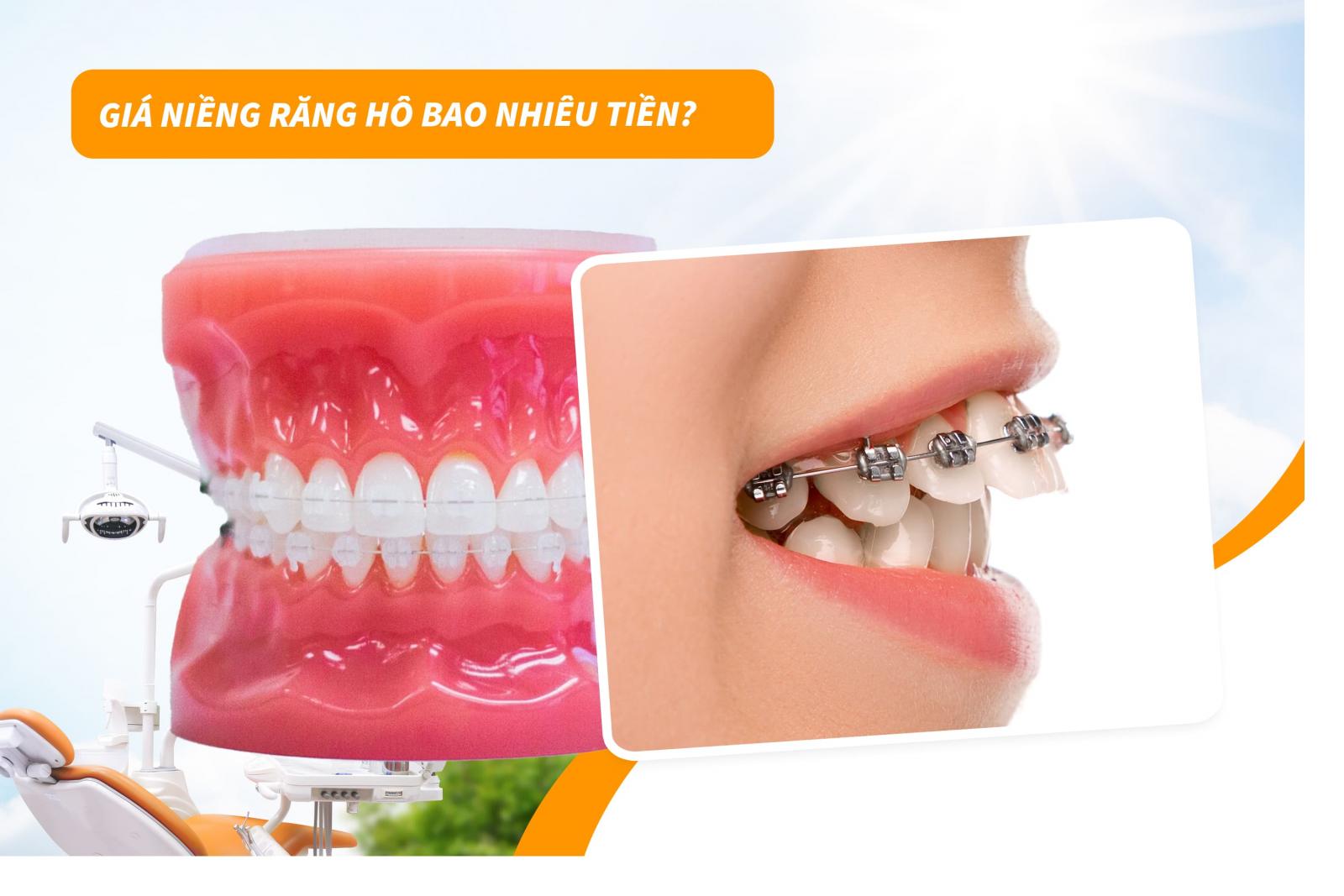 Giá niềng răng hô bao nhiêu tiền?