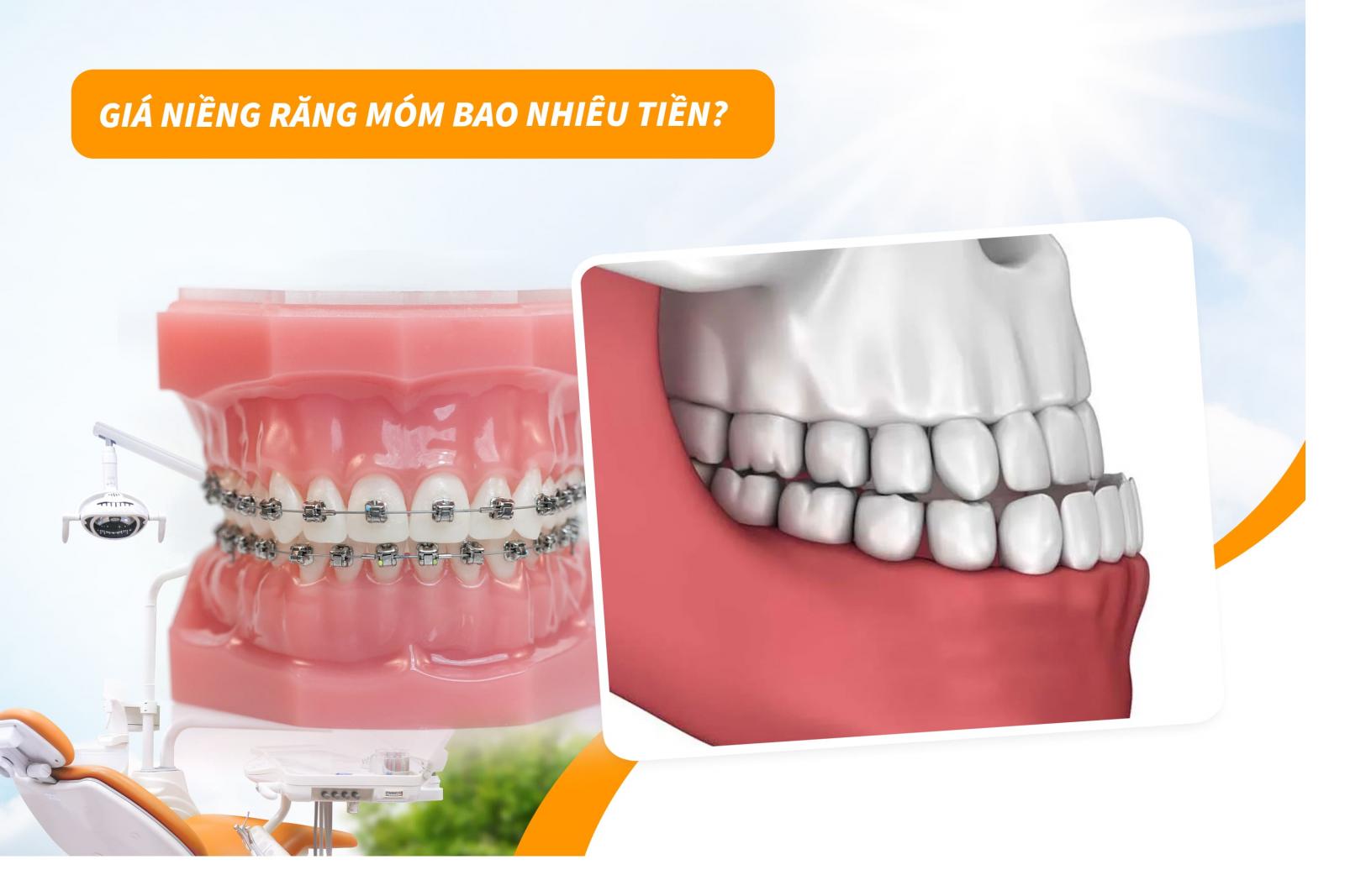 Giá niềng răng móm bao nhiêu tiền?