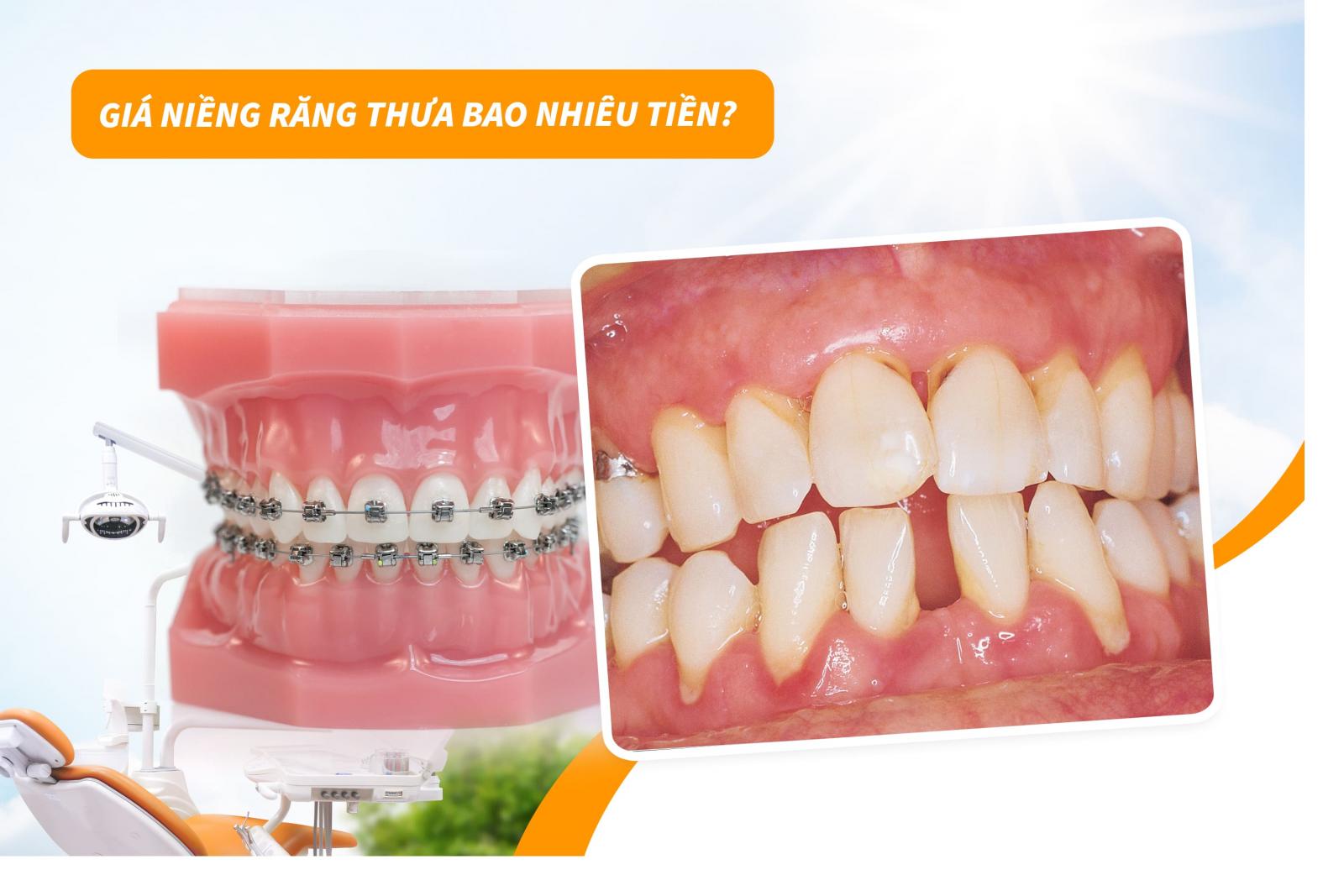Giá niềng răng thưa bao nhiêu tiền?