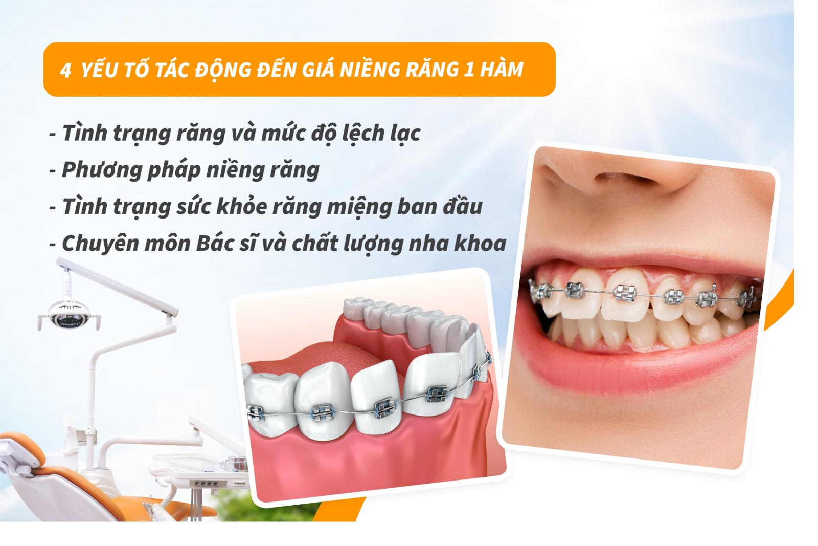 Những yếu tố tác động đến giá niềng răng 1 hàm