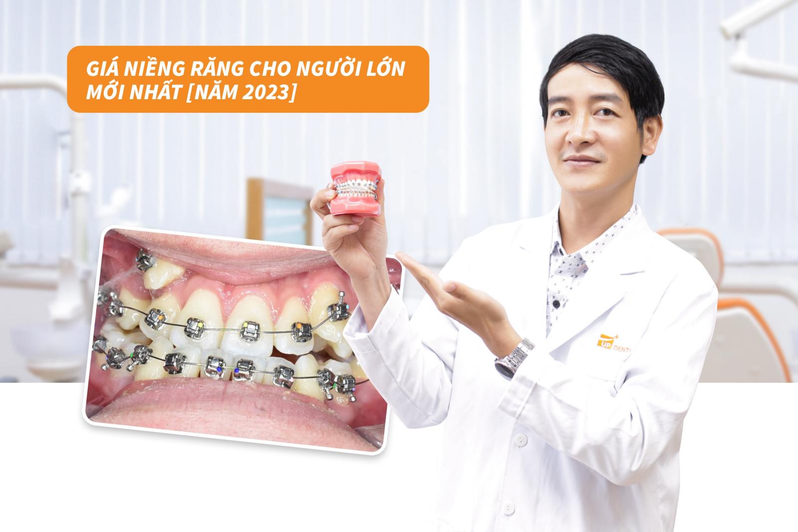 Giá niềng răng cho người lớn mới nhất năm 2023