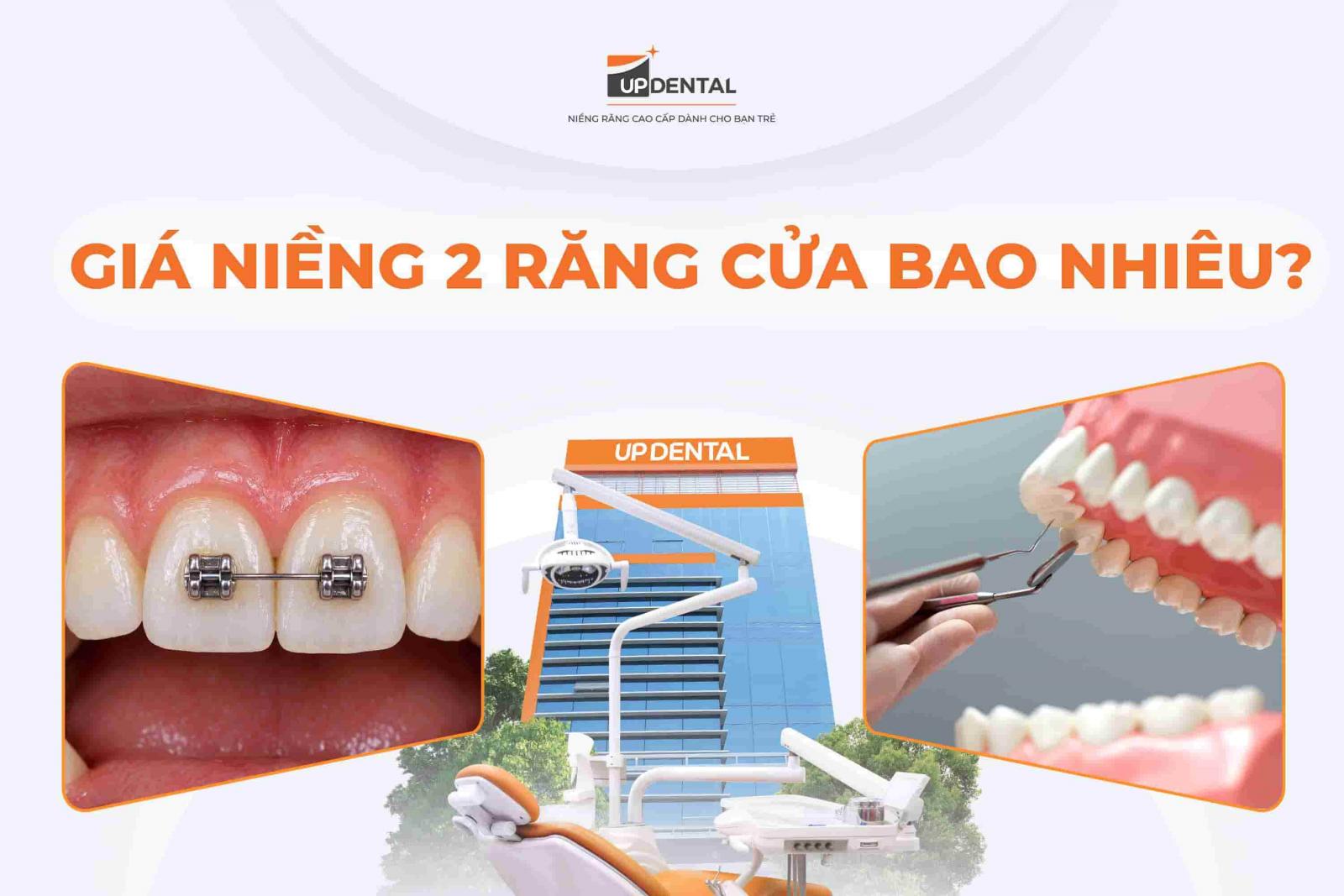 Giá niềng 2 răng cửa bao nhiêu?