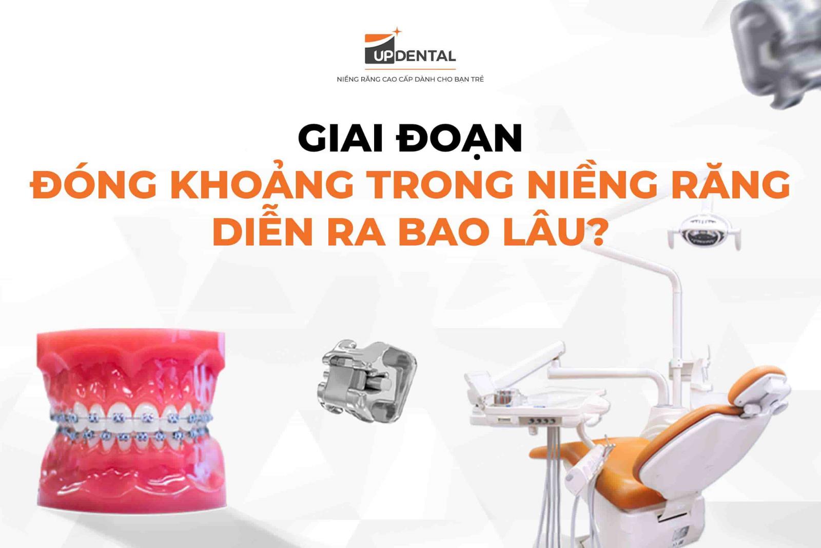 Đóng khoảng trong niềng răng diễn ra bao lâu?