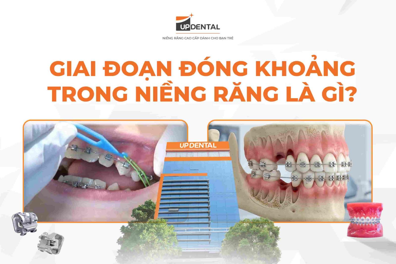 Giai đoạn đóng khoảng trong niềng răng là gì?
