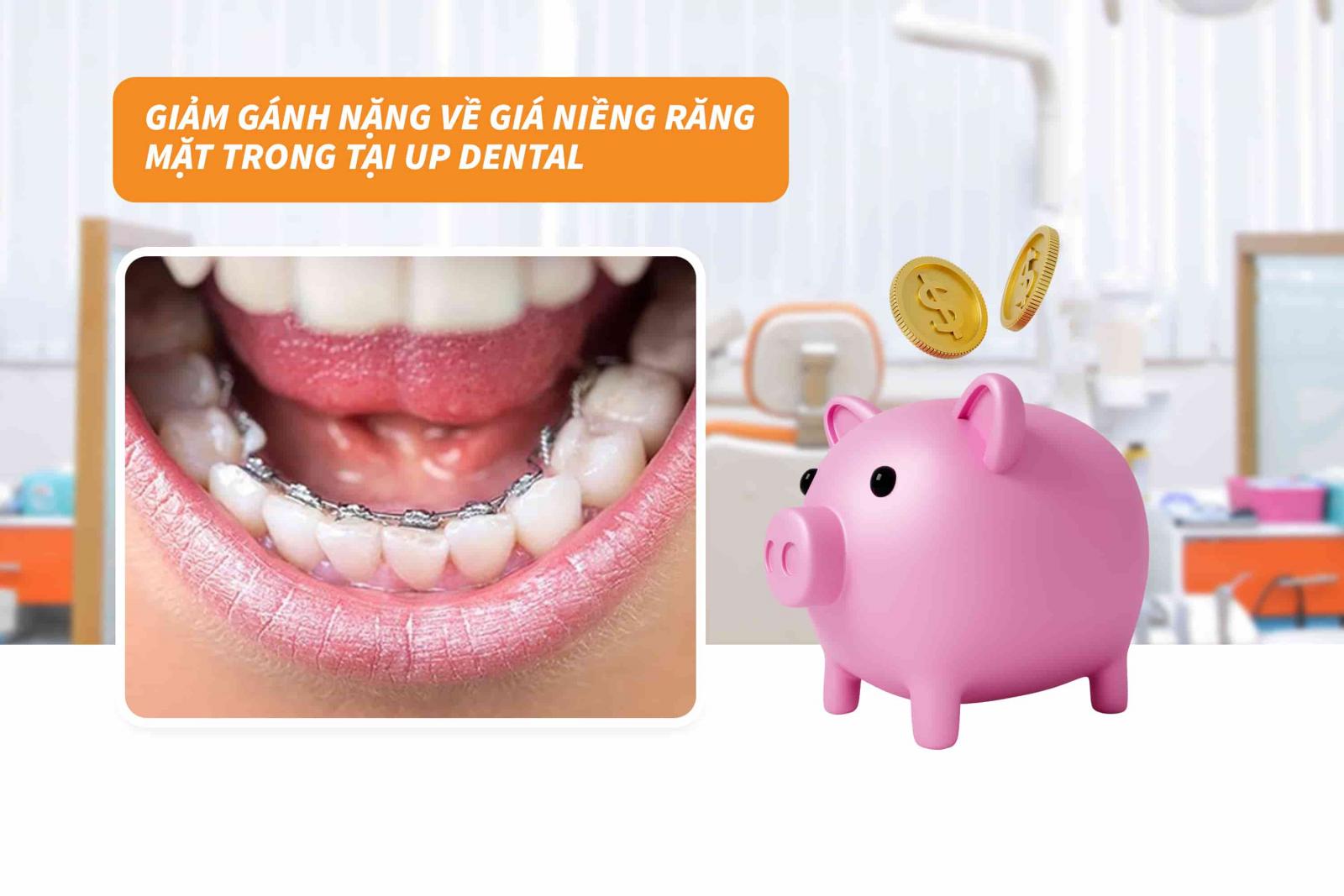 Giảm gánh nặng về giá niềng răng mặt trong tại Up Dental