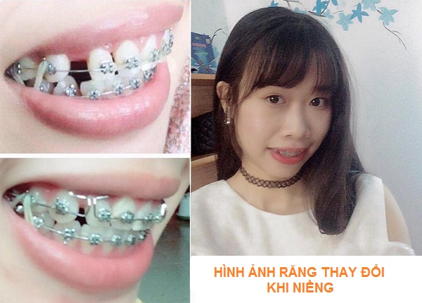 hinh anh rang thay doi truoc va sau khi nieng