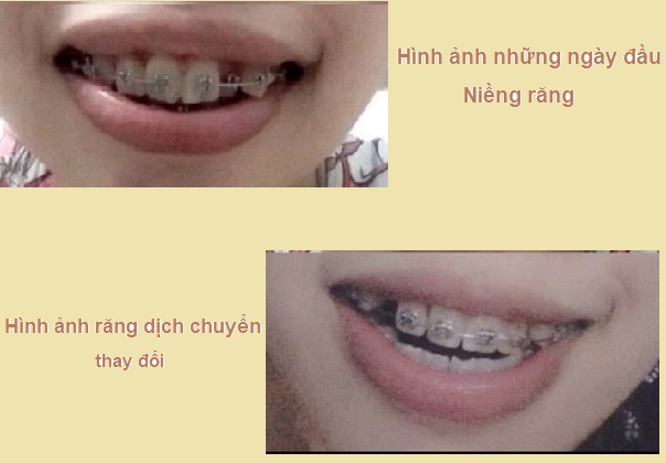 Hinh anh deo nieng rang tai nha khoa up dental