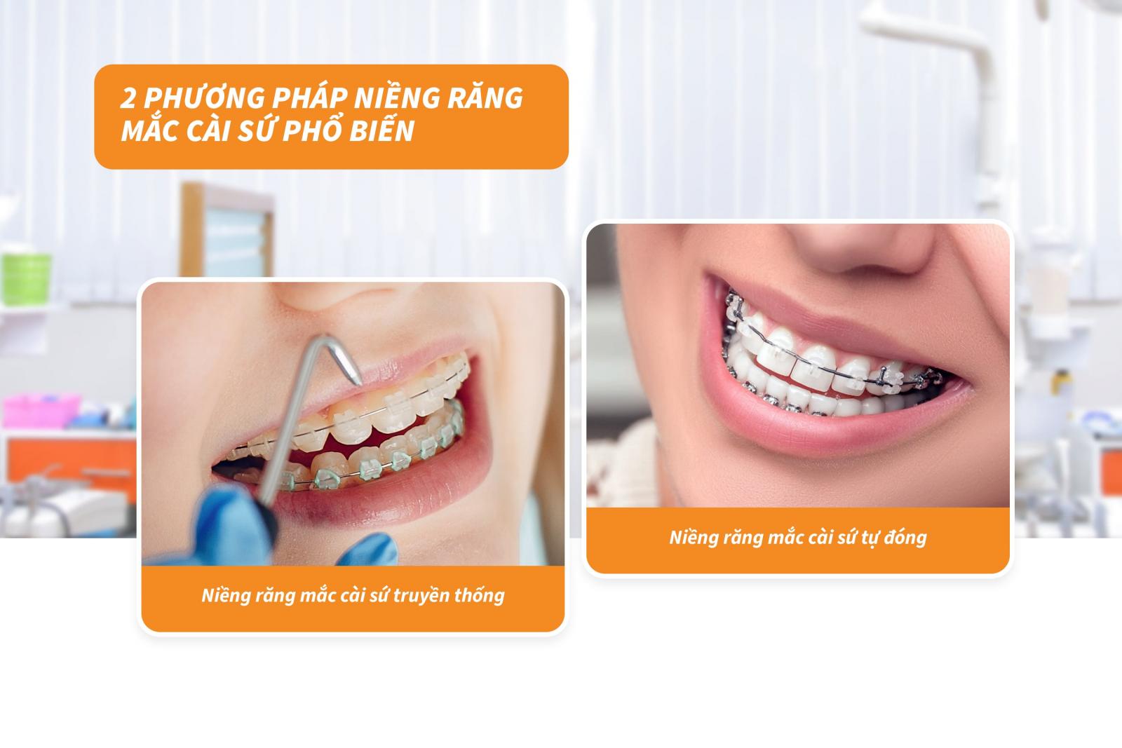 2 phương pháp niềng răng mắc cài sứ phổ biến