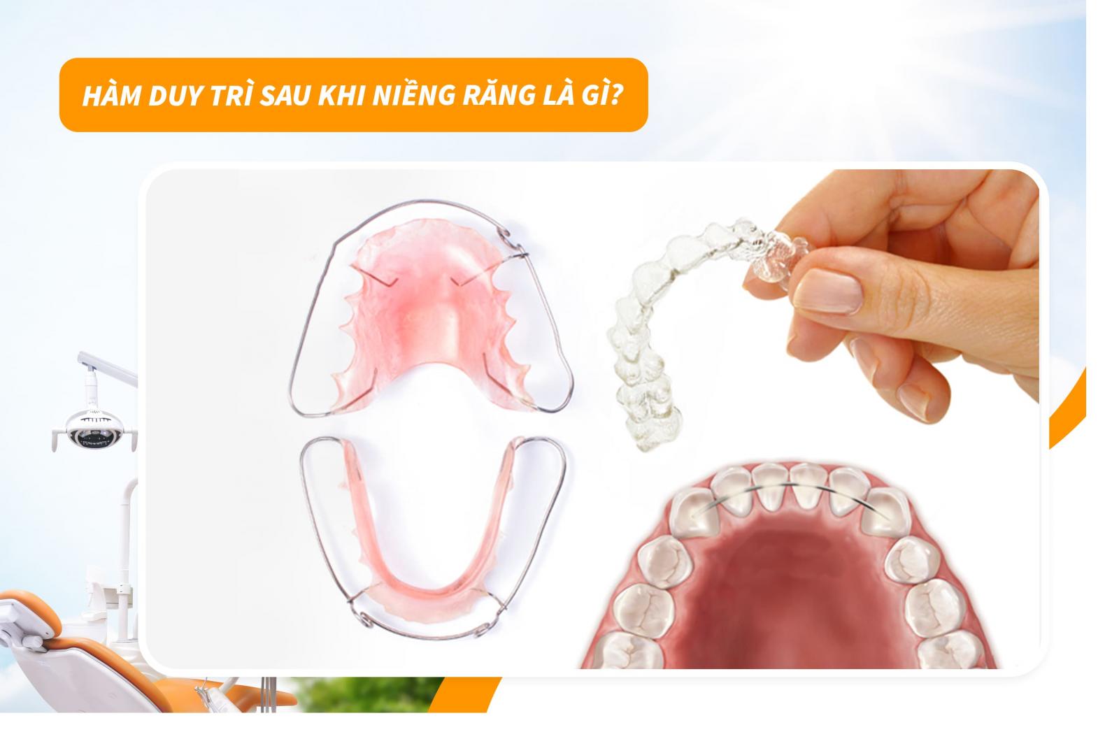 Hàm duy trì sau khi niềng răng là gì?