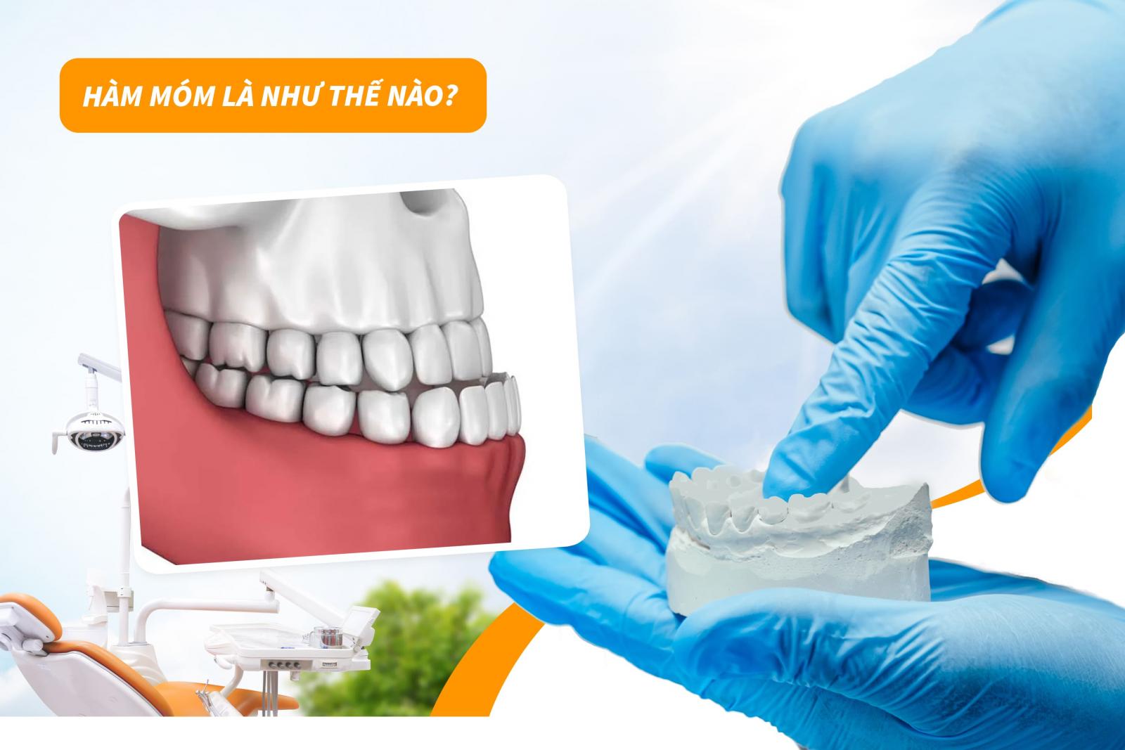 Hàm móm là như thế nào? 