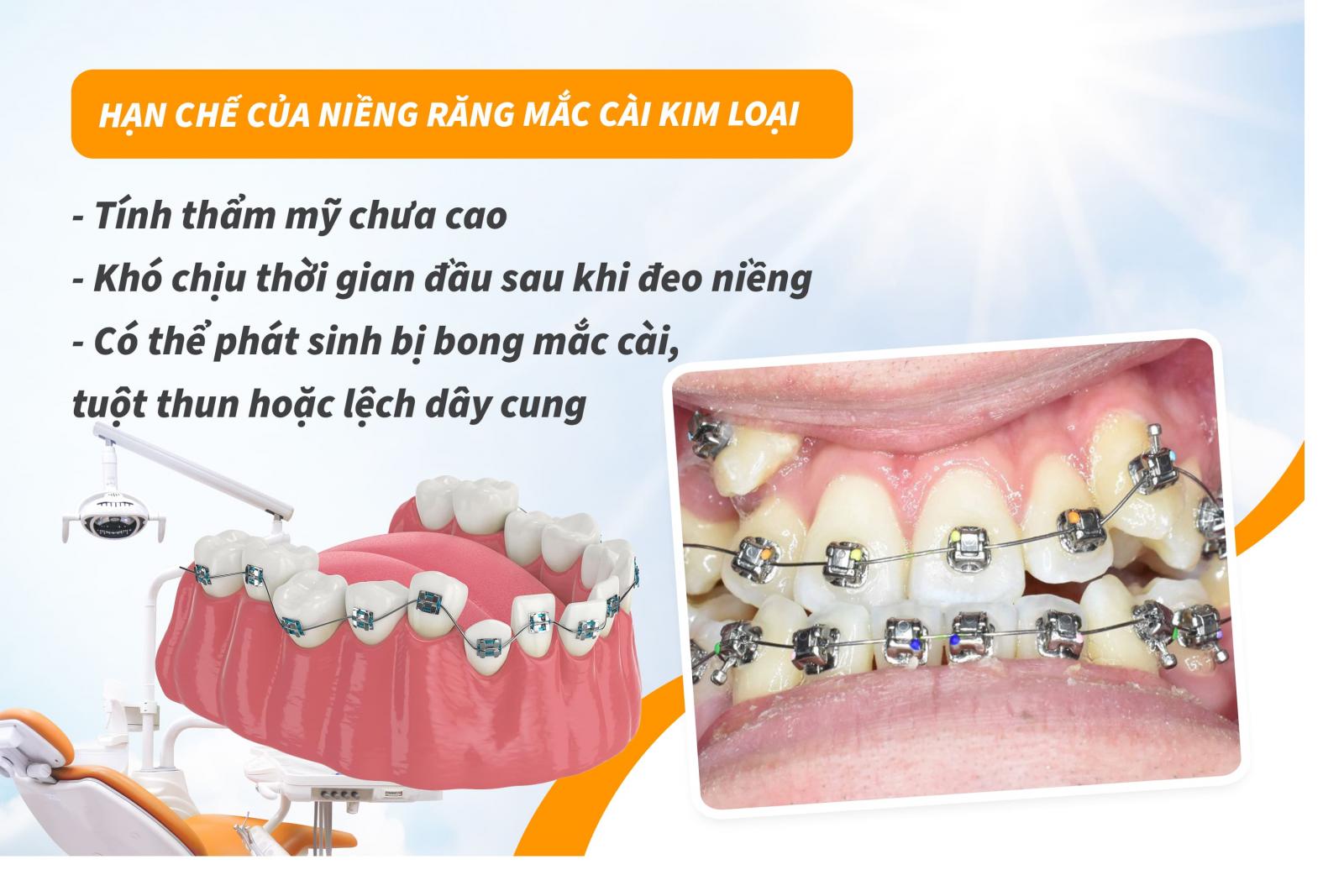 Hạn chế của niềng răng mắc cài kim loại
