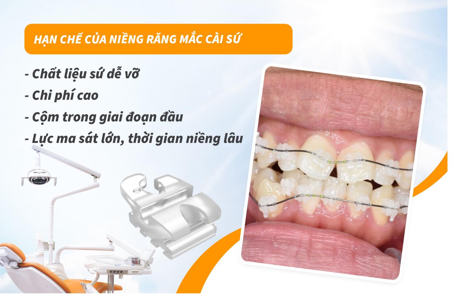 Hạn chế của niềng răng mắc cài sứ
