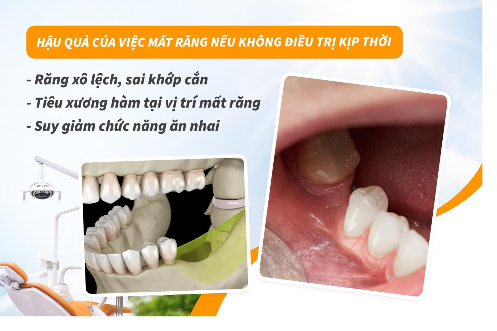 Hậu quả của việc mất răng nếu không điều trị kịp thời