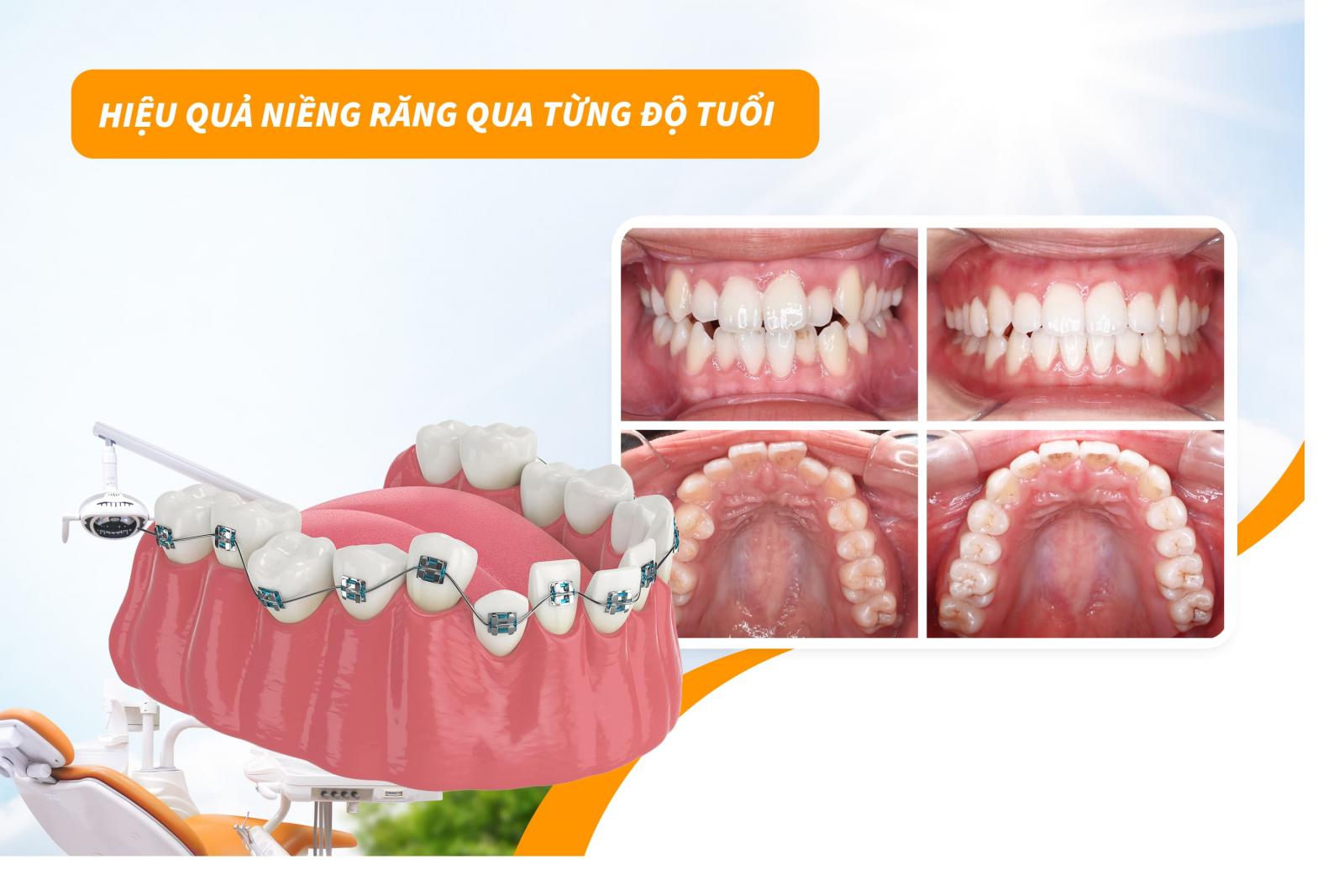 Hiệu quả niềng răng qua từng độ tuổi
