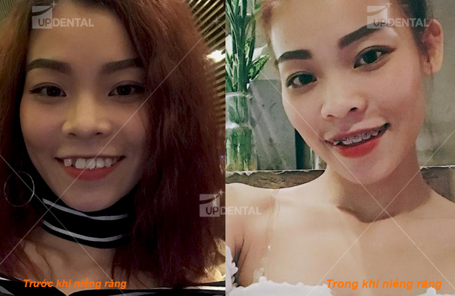 hinh anh truoc va sau nieng rang