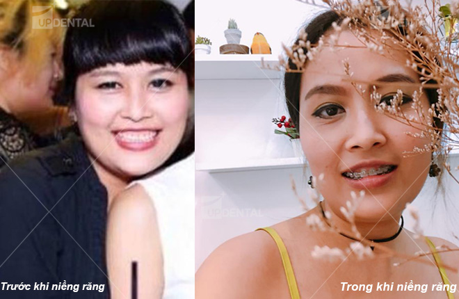 hinh anh rang truoc va sau khi nieng