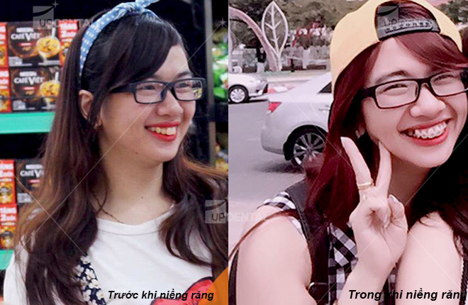 hinh anh truoc va trong qua trinh nieng rang