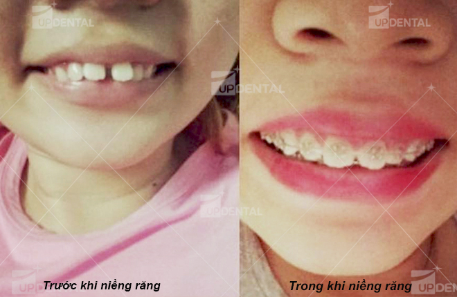 hinh anh rang thay doi truoc và trong khi nieng rang