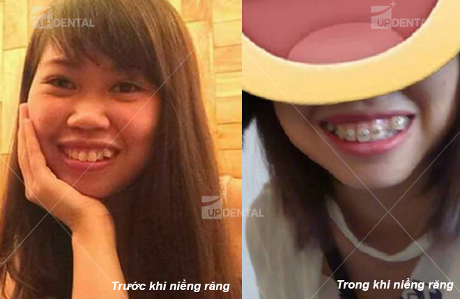 hinh anh rang truoc va sau khi nieng