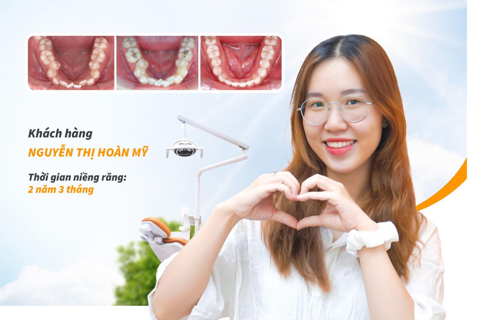 Khách hàng niềng răng trong suốt tại Up Dental