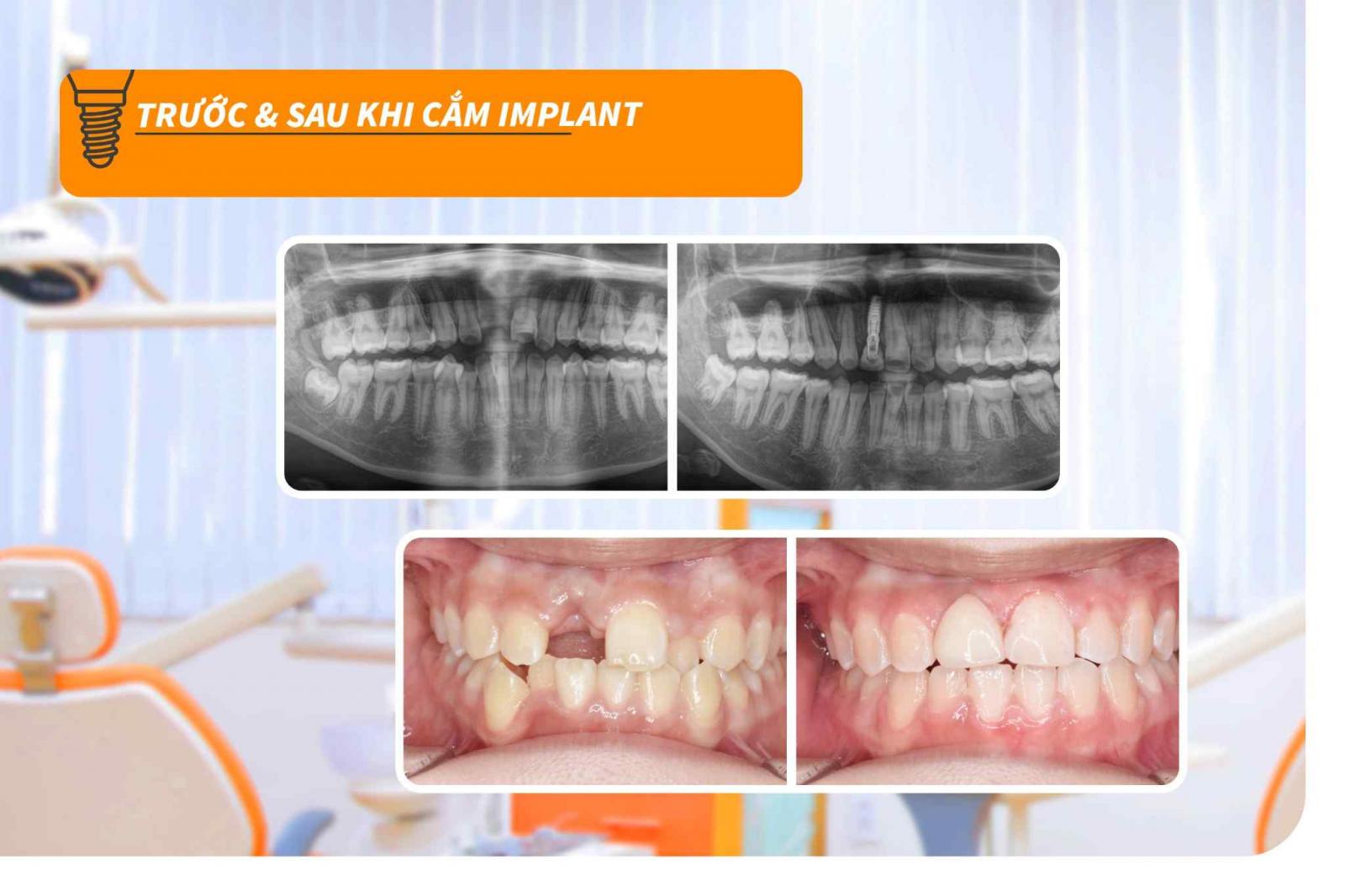 Hình ảnh trước - sau khi trồng răng Implant