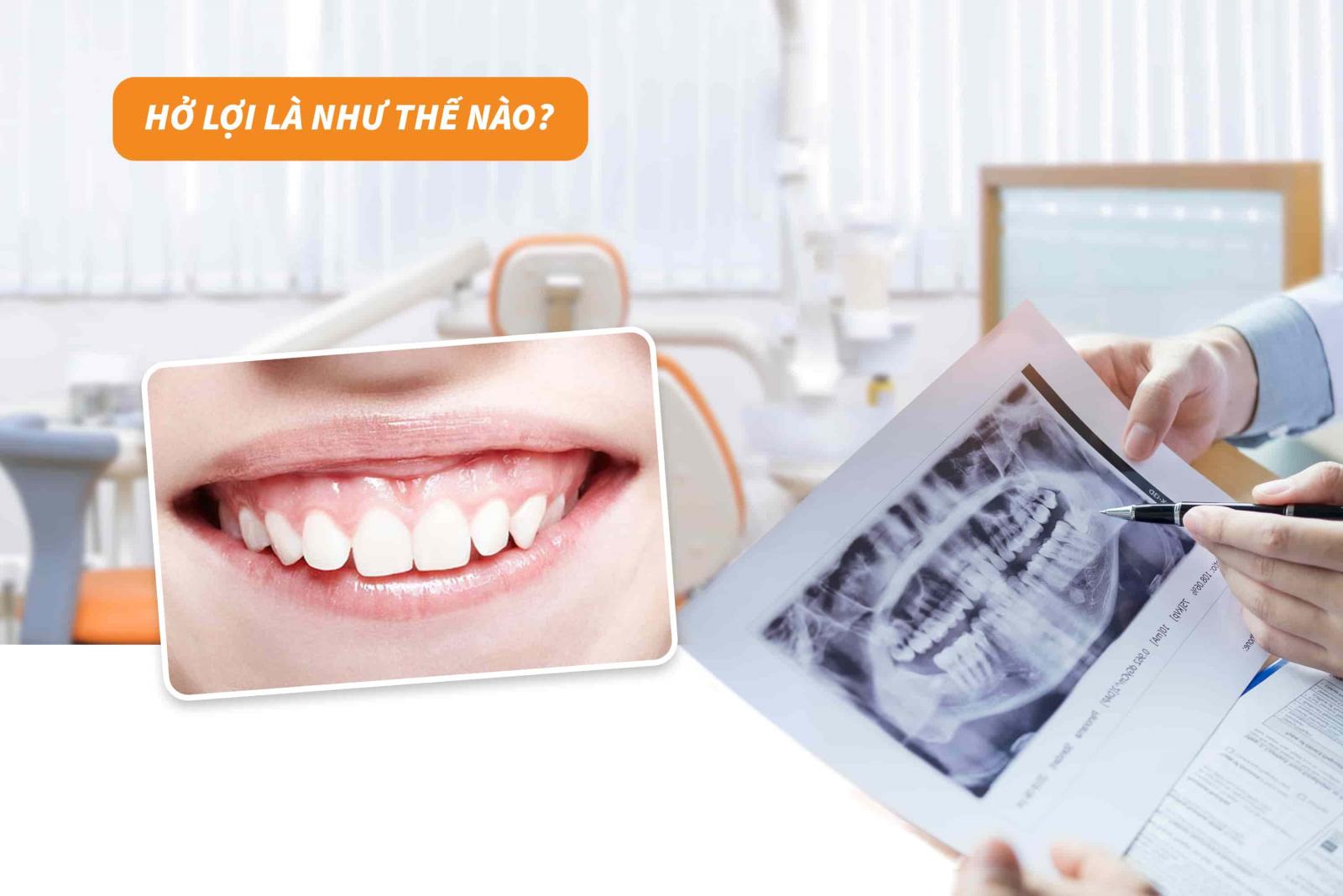 Giải đáp: Niềng răng có bị hở lợi không? | Up Dental