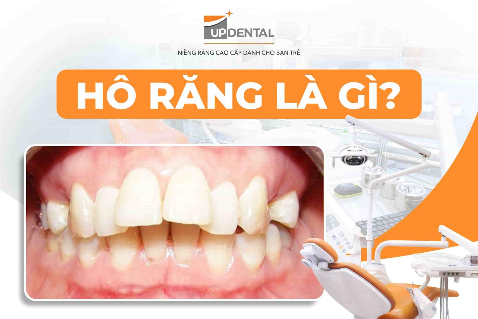 Hô răng là gì?