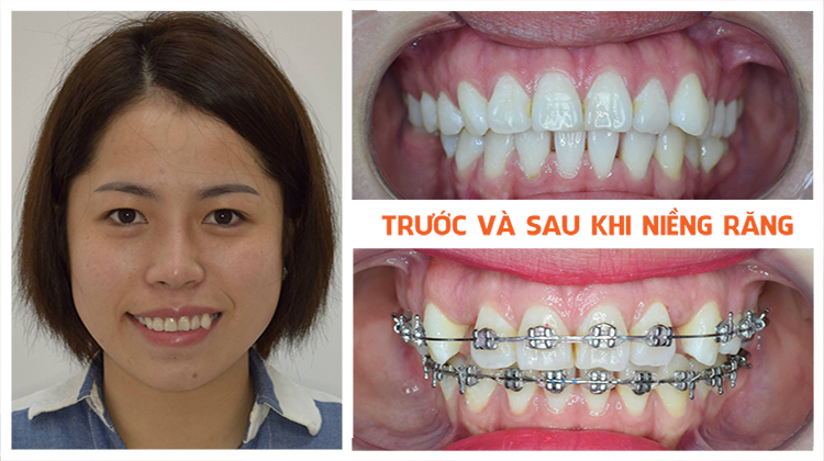 review up dental ket qua nieng rang hô 1 nam
