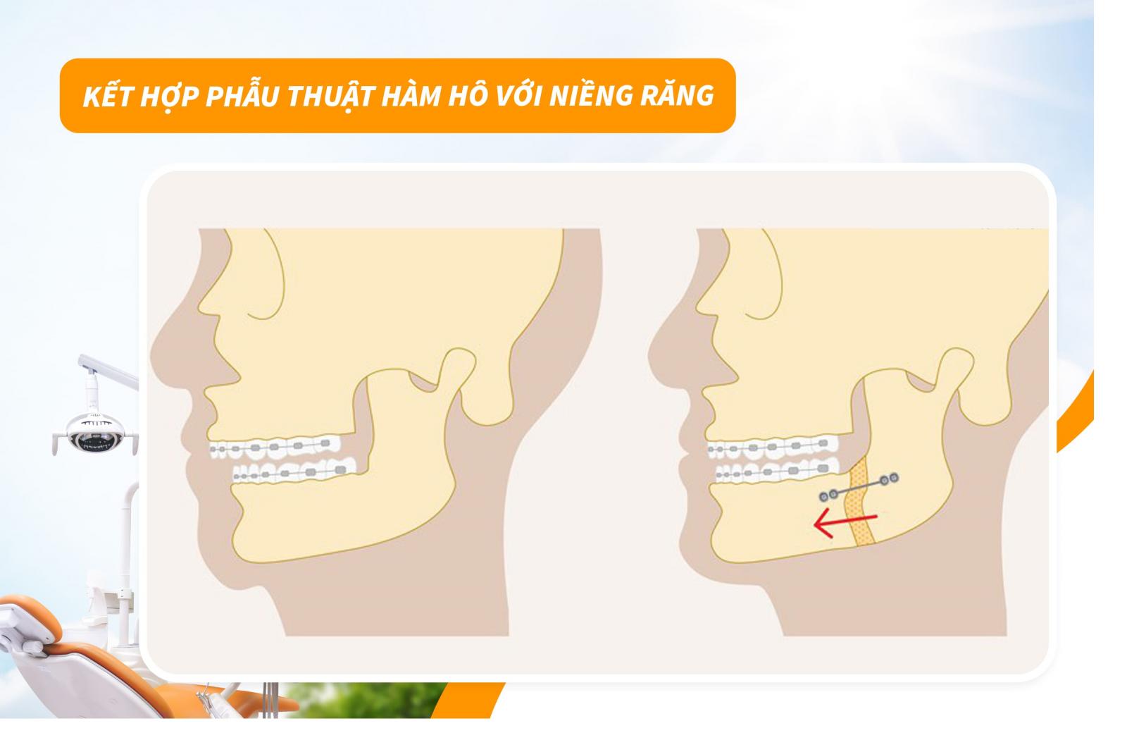Kết hợp phẫu thuật hàm hô với niềng răng