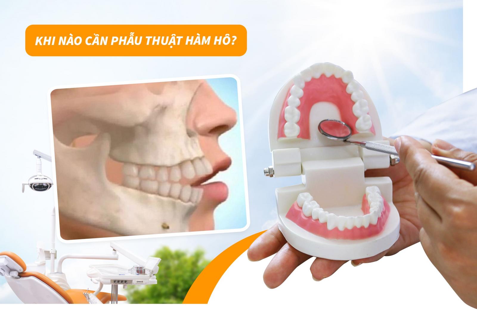 Khi nào cần phẫu thuật hàm hô?