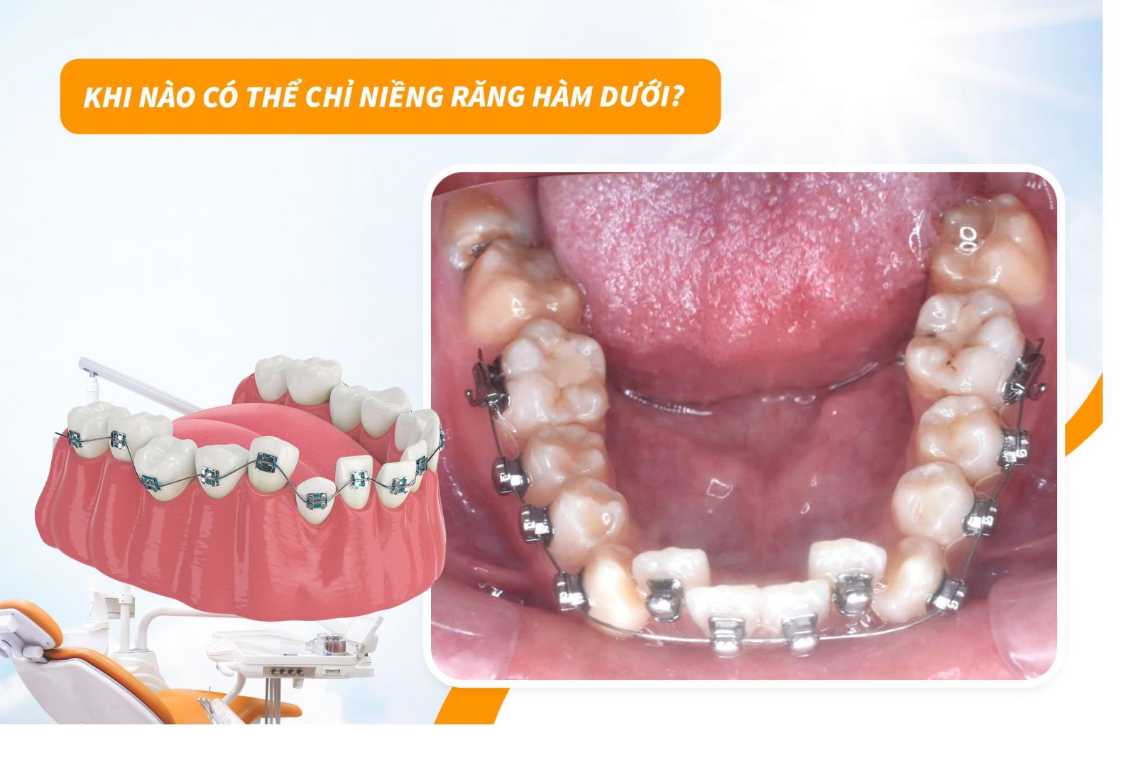 Khi nào có thể chỉ niềng răng hàm dưới?