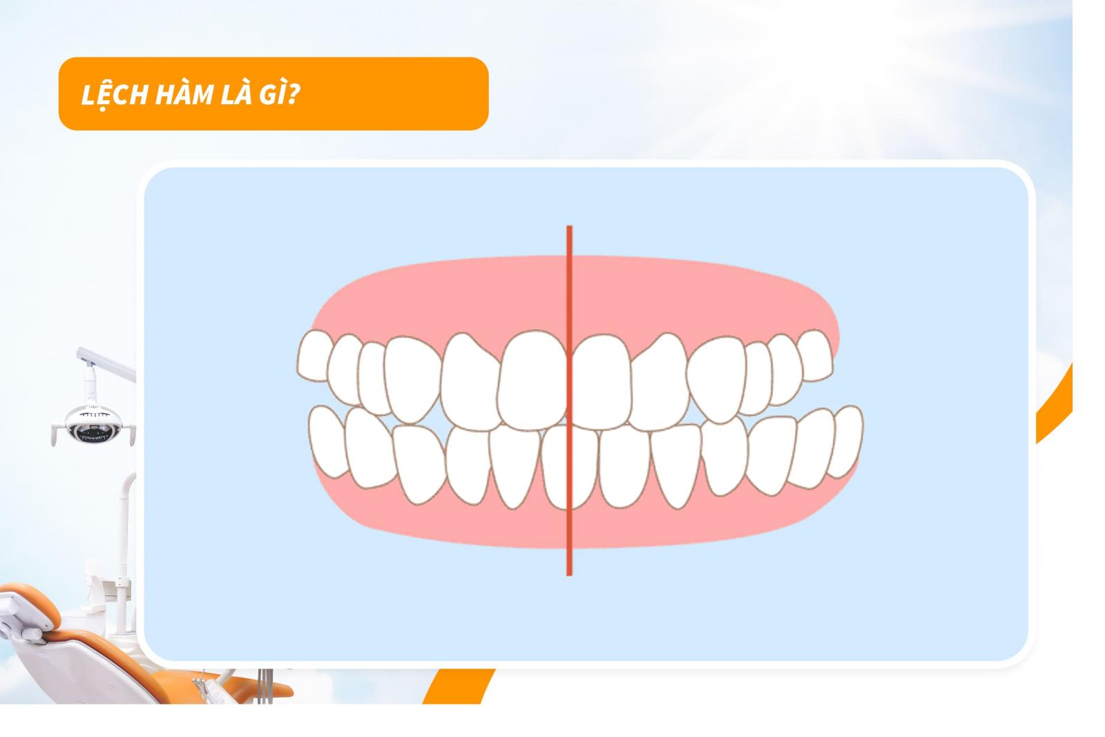 Lệch hàm là gì? 