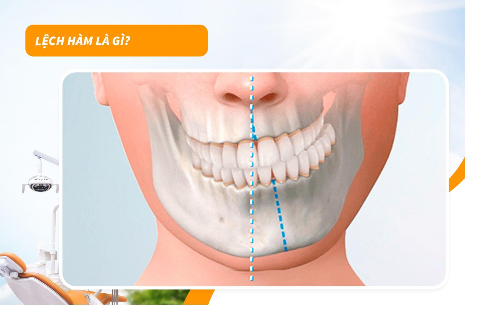 Lệch hàm là gì?