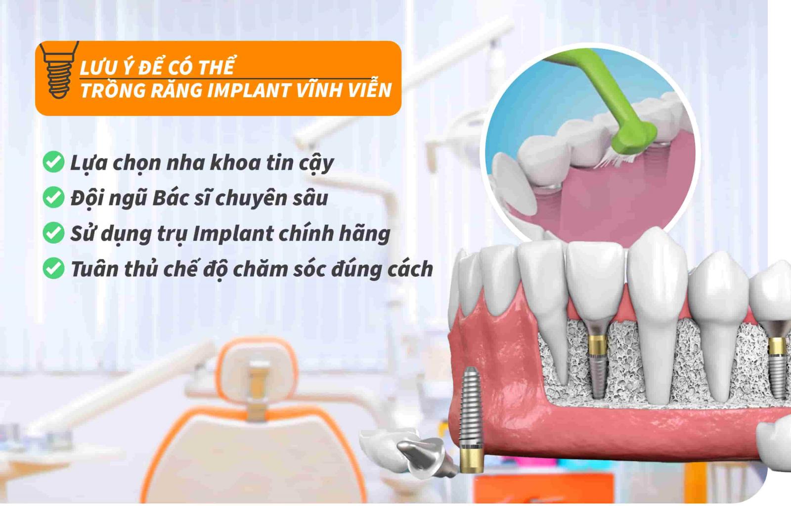 Lưu ý để có thể trồng răng Implant vĩnh viễn