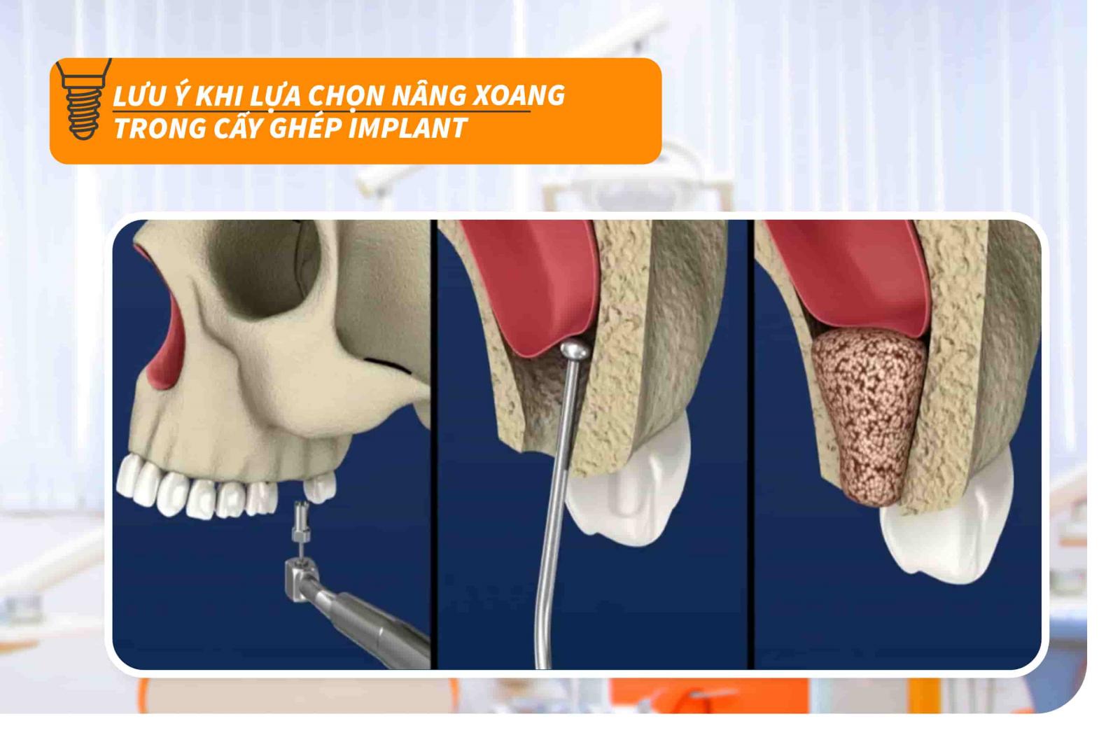 Lưu ý khi lựa chọn nâng xoang trong cấy ghép Implant