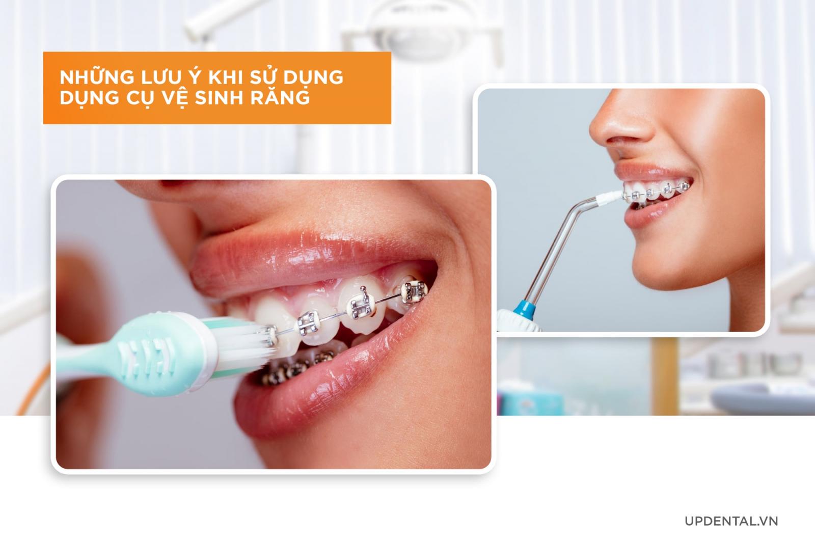 những lưu ý khi sử dụng dụng cụ vệ sinh răng miệng khi niềng răng