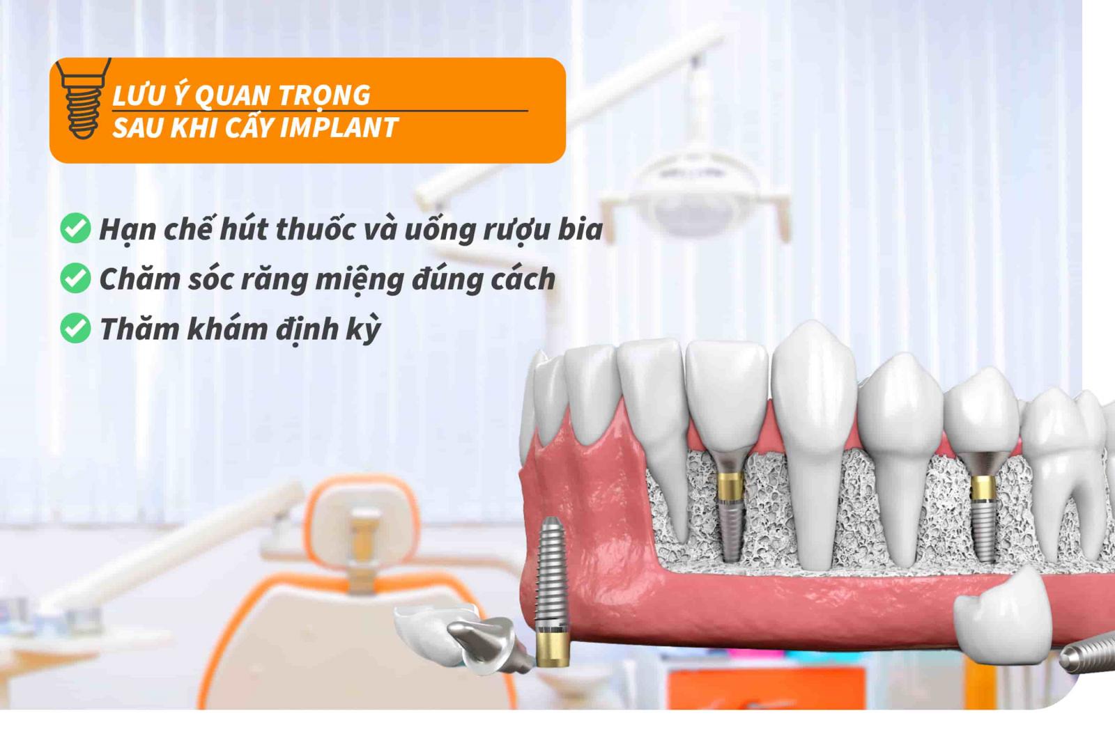 Lưu ý quan trọng sau khi cấy Implant