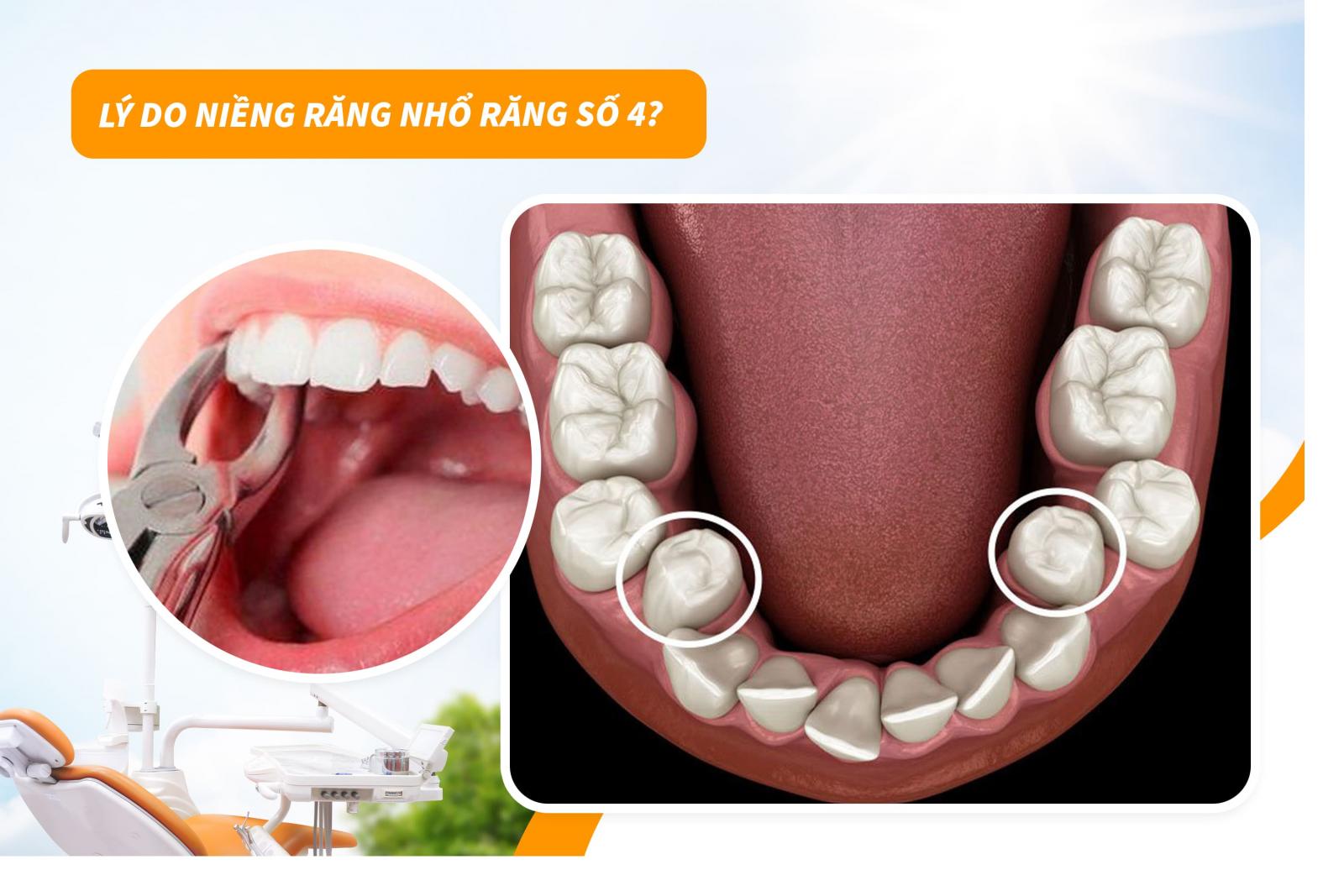 Lý do niềng răng nhổ răng số 4?