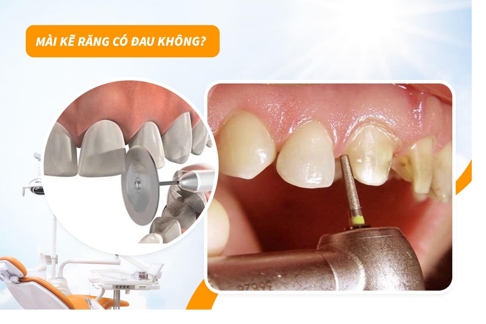 Mài kẽ răng có đau không?