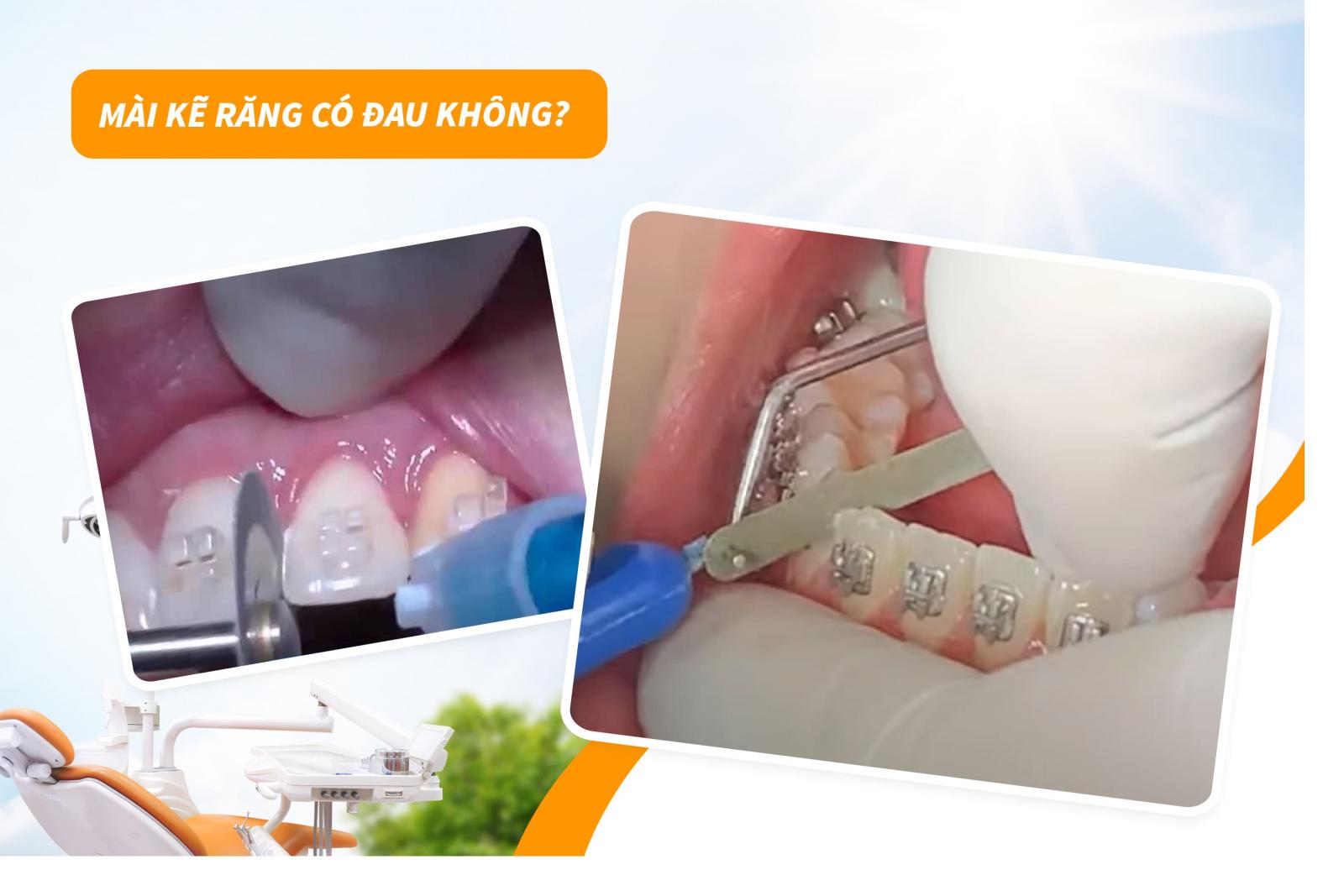 Mài kẽ răng có đau không?