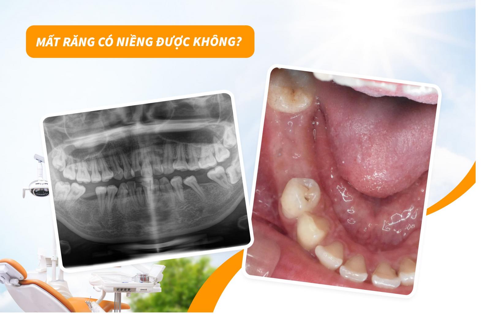 Mất răng có niềng được không?
