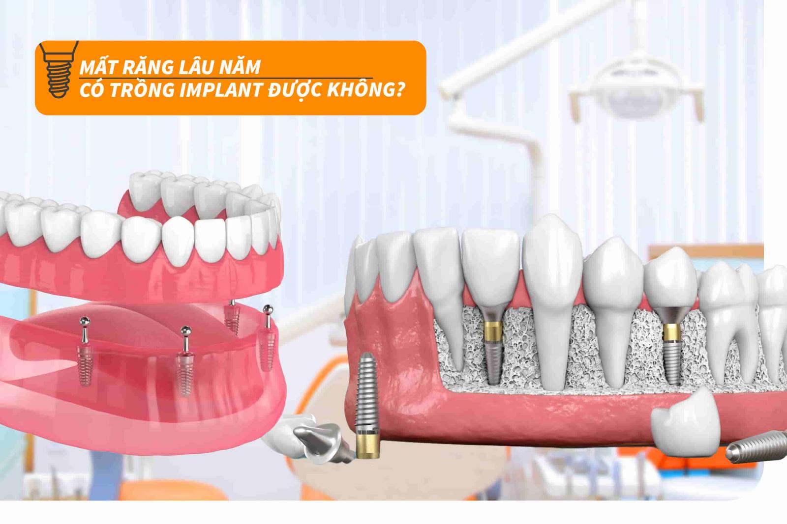 Mất răng lâu năm có trồng Implant được không?