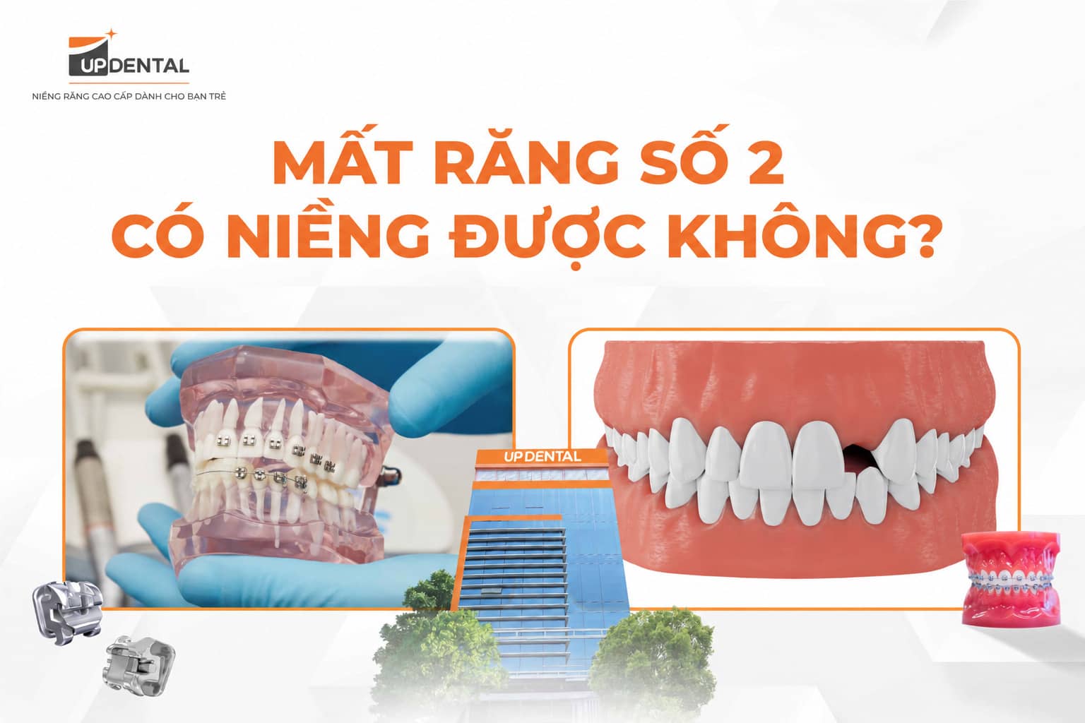 Mất răng số 2 có niềng được không?