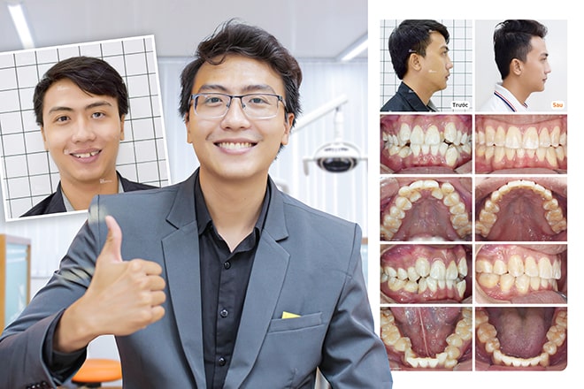 ảnh trước và sau khi niềng răng
