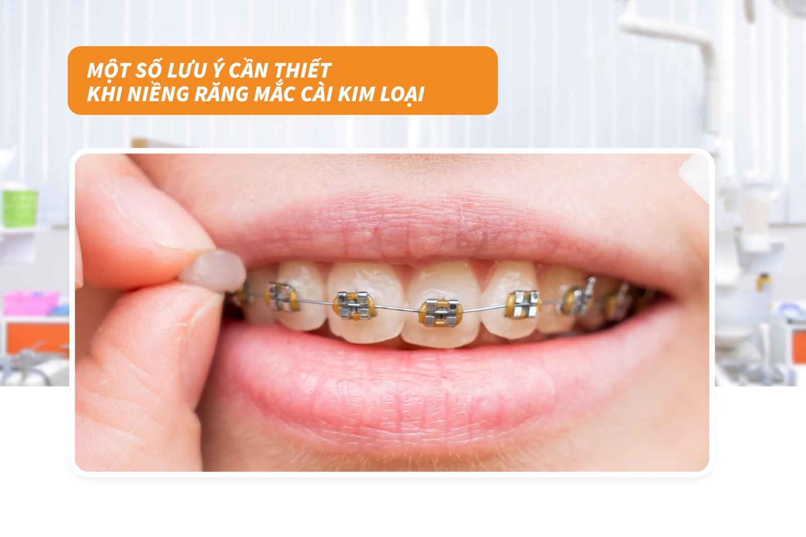 Một số lưu ý cần thiết khi niềng răng mắc cài kim loại 