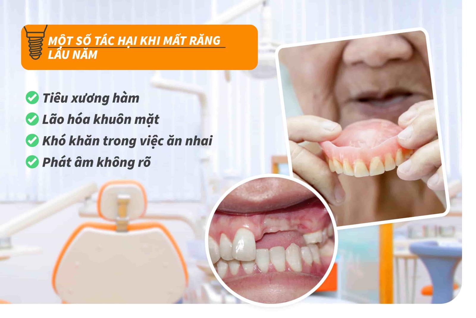 Một số tác hại khi mất răng lâu năm