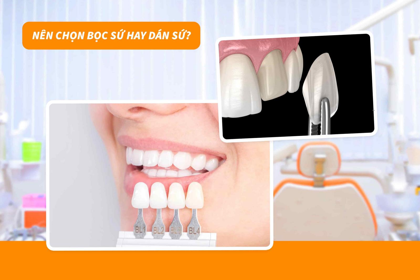 Nên chọn bọc sứ hay dán sứ