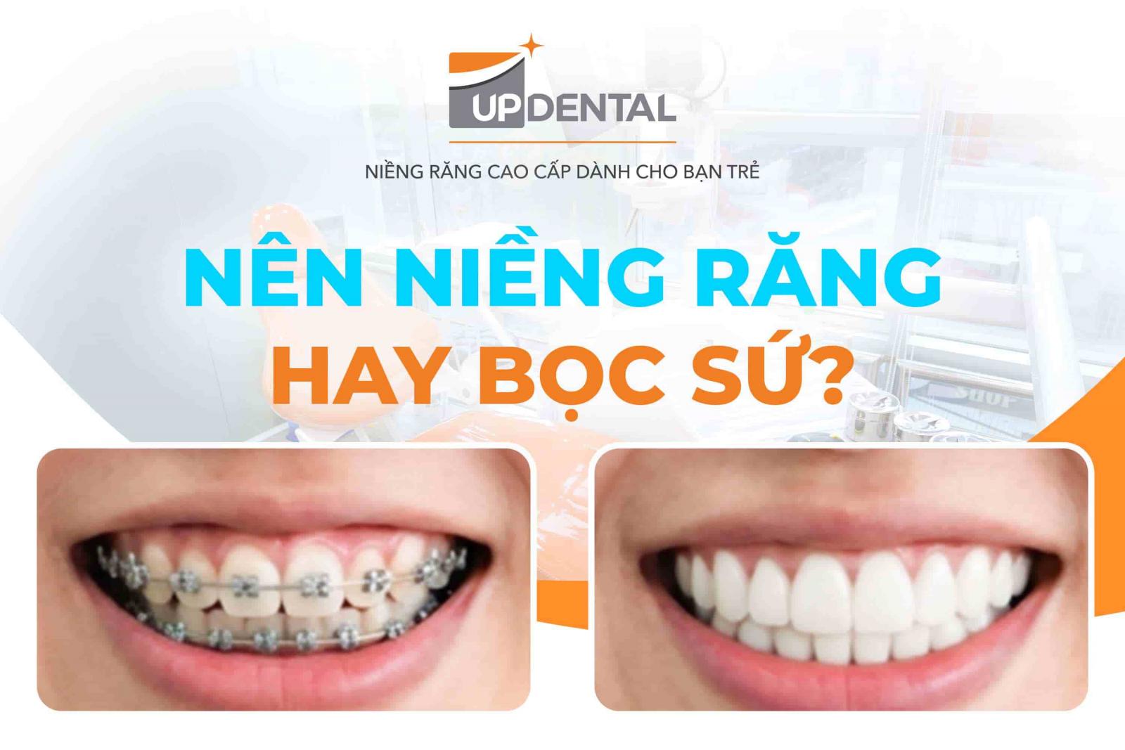 Nên niềng răng hay bọc sứ?